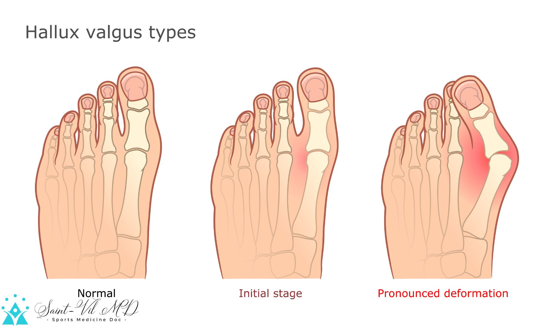 Medical vector illustration of Hallux valgus types. Healthy foot ...