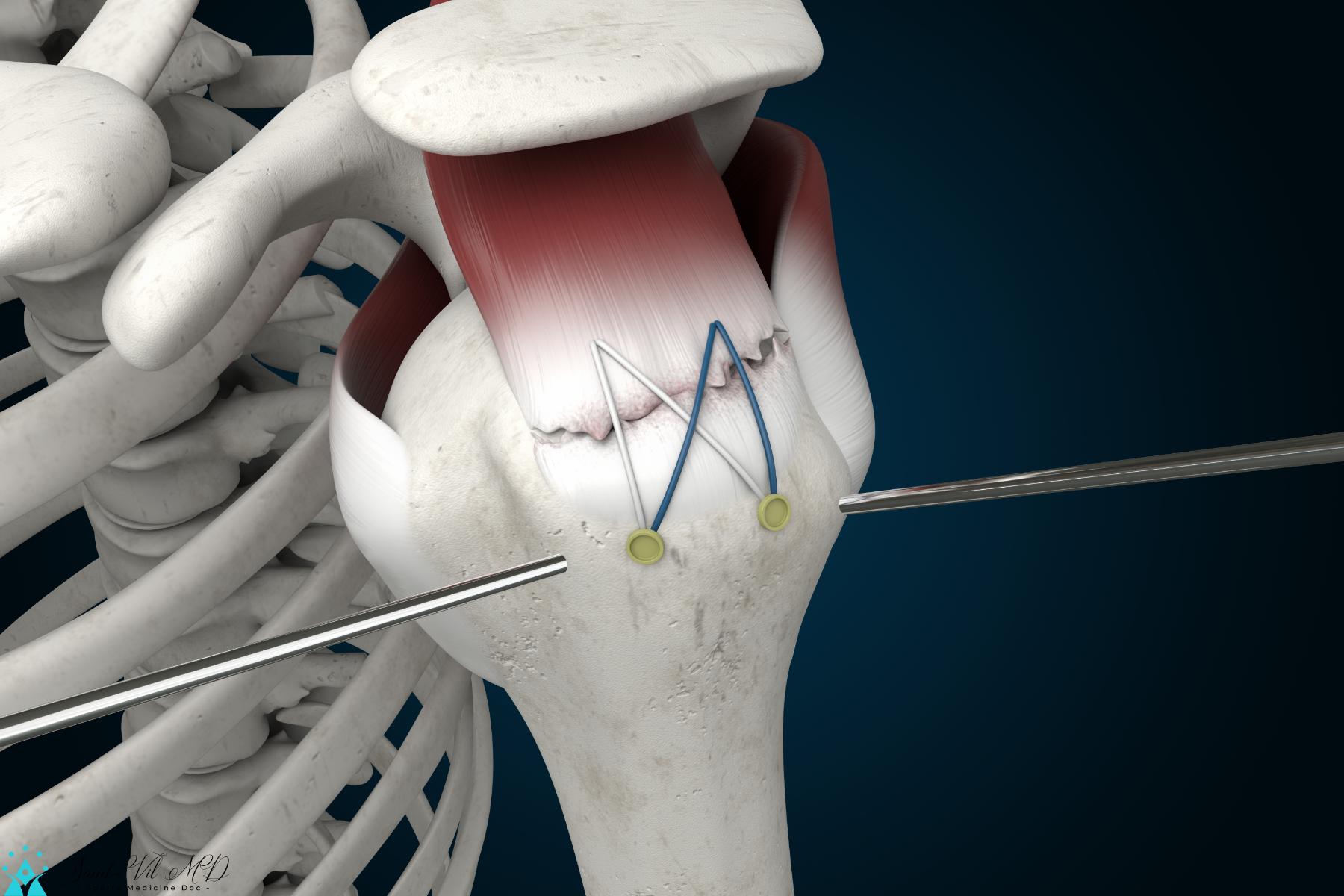 Rotator Cuff Repair Surgery 3d Rendering Supraspinatus Tear Shoulder Anatomy Exercisenow